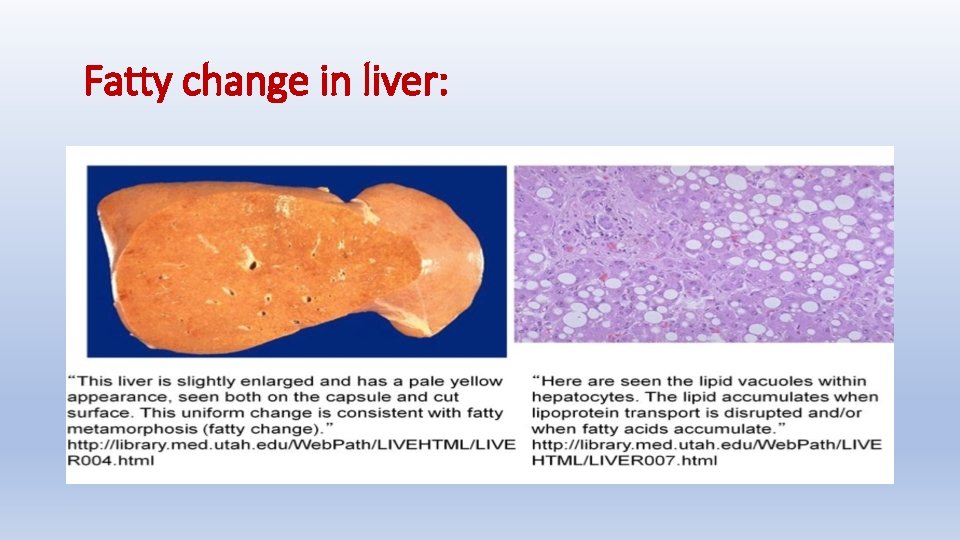 Fatty change in liver: 