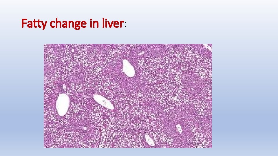 Fatty change in liver: 