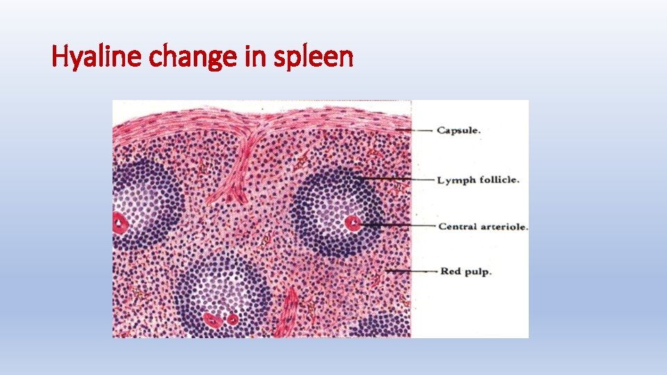 Hyaline change in spleen 