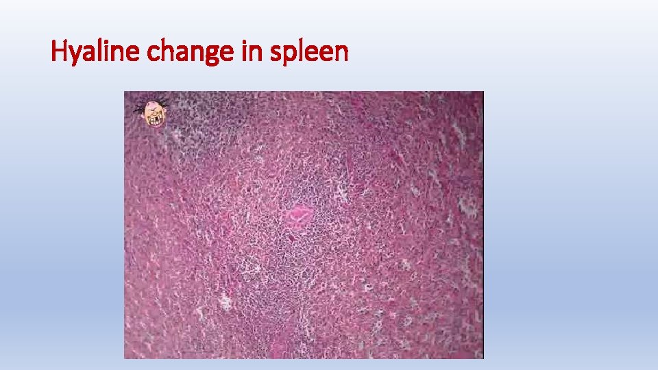 Hyaline change in spleen 