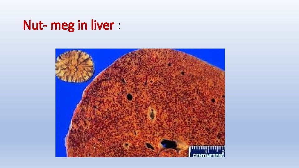 Nut- meg in liver : 