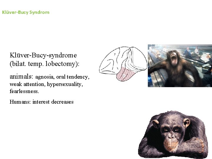 Klüver-Bucy Syndrom Klüver-Bucy-syndrome (bilat. temp. lobectomy): animals: agnosia, oral tendency, weak attention, hypersexuality, fearlessness.