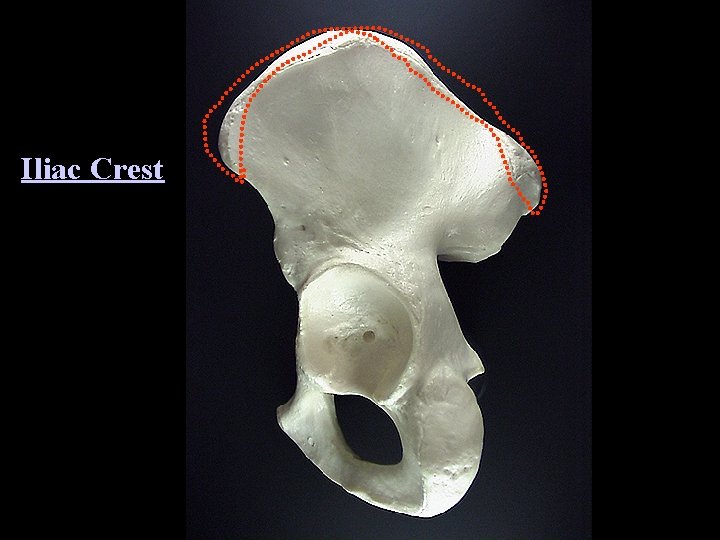 Iliac Crest 