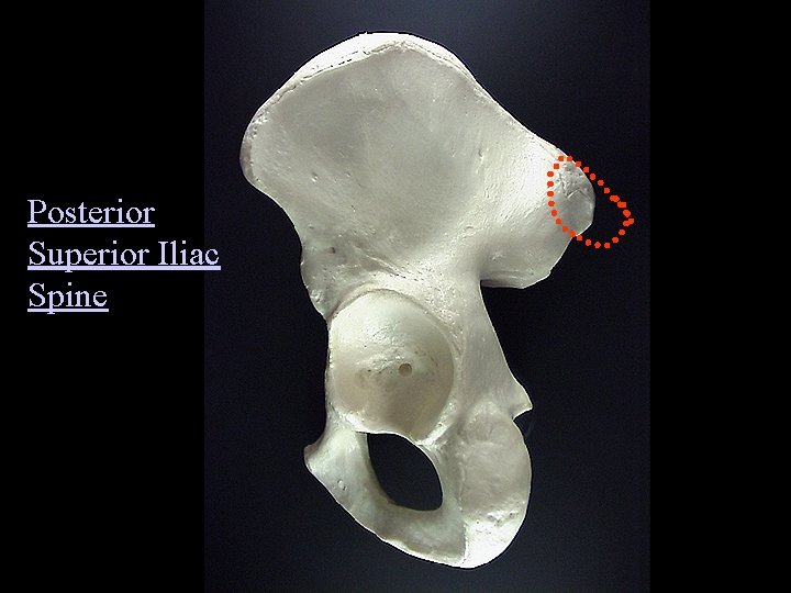 Posterior Superior Iliac Spine 