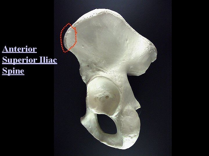 Anterior Superior Iliac Spine 