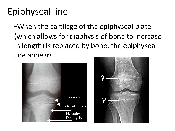 Epiphyseal line -When the cartilage of the epiphyseal plate (which allows for diaphysis of