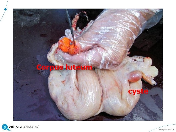 Corpus luteum cyste 