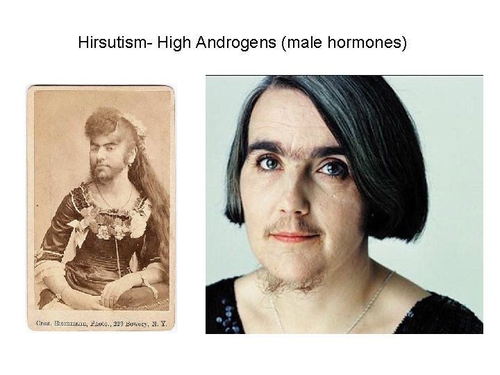 Hirsutism- High Androgens (male hormones) 