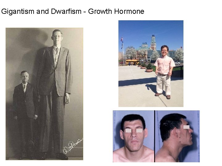 Gigantism and Dwarfism - Growth Hormone 