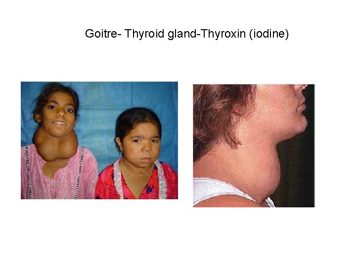 Goitre- Thyroid gland-Thyroxin (iodine) 