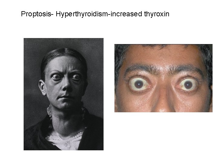 Proptosis- Hyperthyroidism-increased thyroxin 