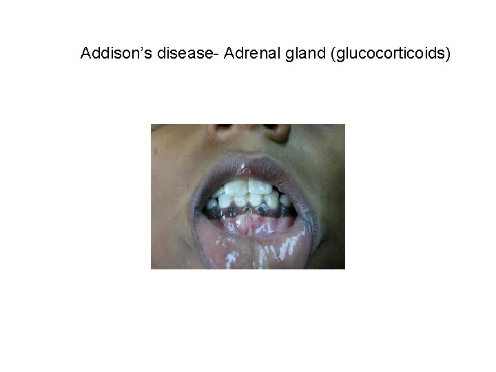 Addison’s disease- Adrenal gland (glucocorticoids) 