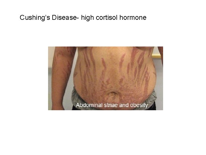 Cushing’s Disease- high cortisol hormone 