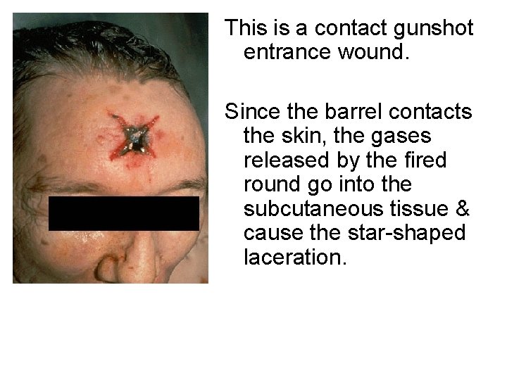 This is a contact gunshot Contact Gunshot wound entrance wound. Since the barrel contacts