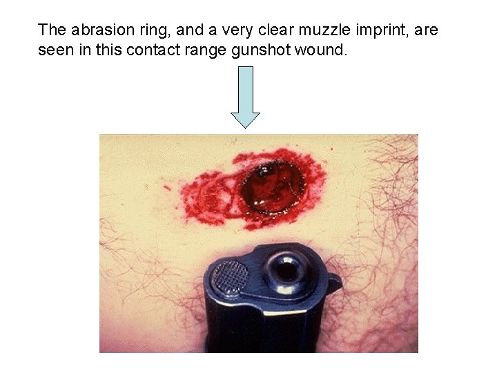 Abrasion Ring The abrasion ring, and a very clear muzzle imprint, are seen in