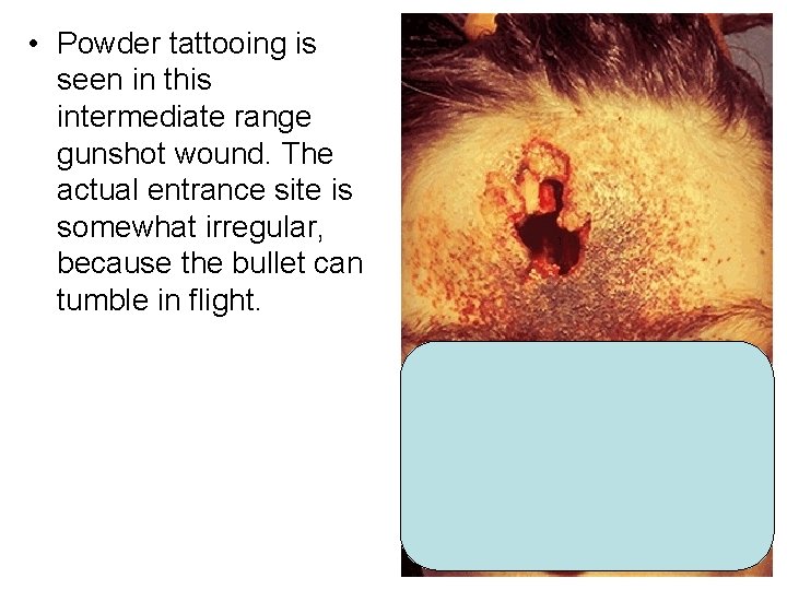  • Powder tattooing is seen in this intermediate range gunshot wound. The actual