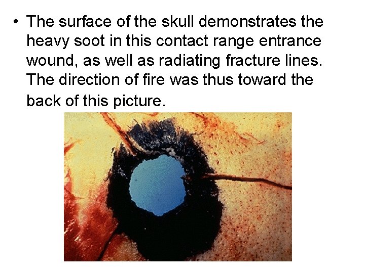  • The surface of the skull demonstrates the heavy soot in this contact