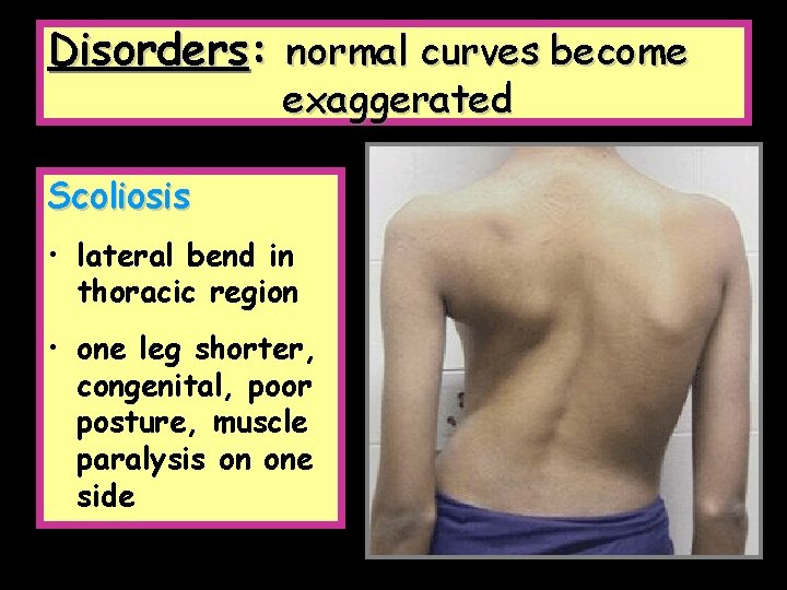 Disorders: normal curves become exaggerated Scoliosis • lateral bend in thoracic region • one