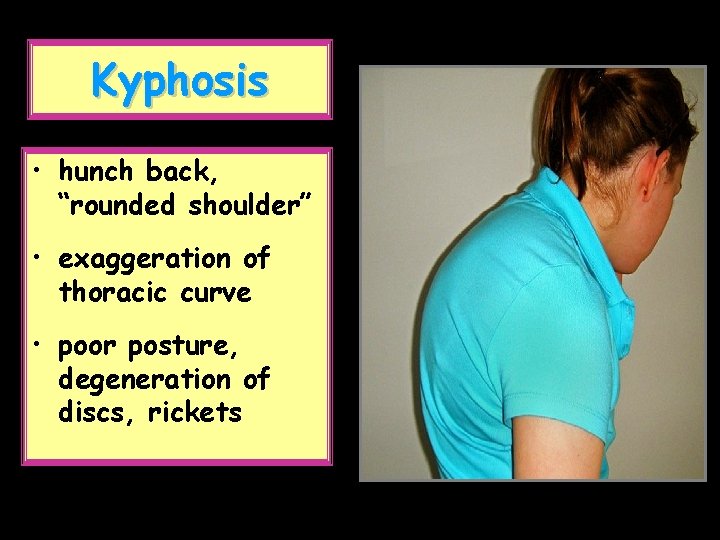 Kyphosis • hunch back, “rounded shoulder” • exaggeration of thoracic curve • poor posture,