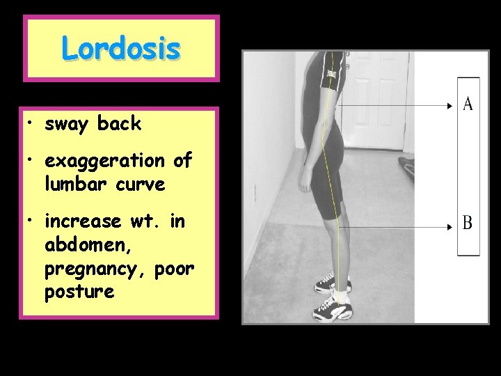 Lordosis • sway back • exaggeration of lumbar curve • increase wt. in abdomen,