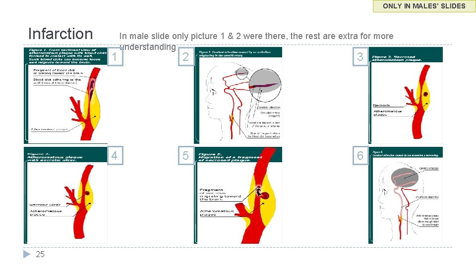 ONLY IN MALES’ SLIDES Infarction 1 4 25 In male slide only picture 1