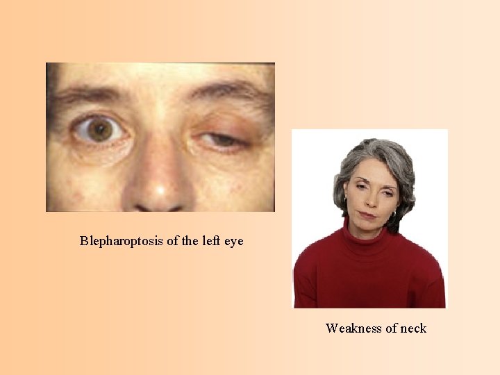Blepharoptosis of the left eye Weakness of neck 