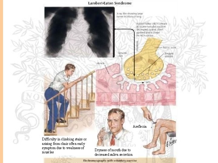 Areflexia Difficulty in climbing stairs or arising from chair often early symptom due to