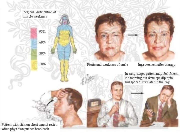 Regional distribution of muscle weakness 95% 60% 30% 10% Ptosis and weakness of smile