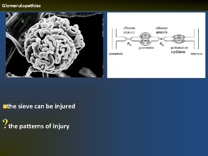 Glomerulopathies the sieve can be injured ? the patterns of injury 