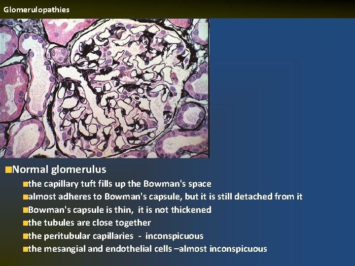 Glomerulopathies Normal glomerulus the capillary tuft fills up the Bowman's space almost adheres to