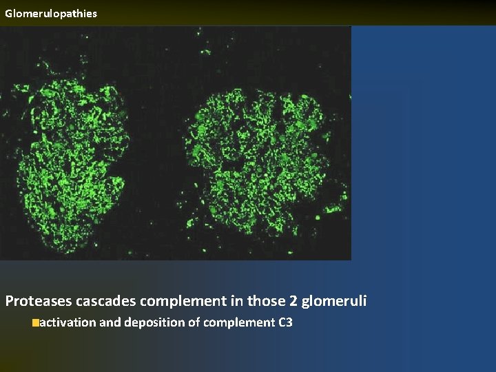 Glomerulopathies Proteases cascades complement in those 2 glomeruli activation and deposition of complement C