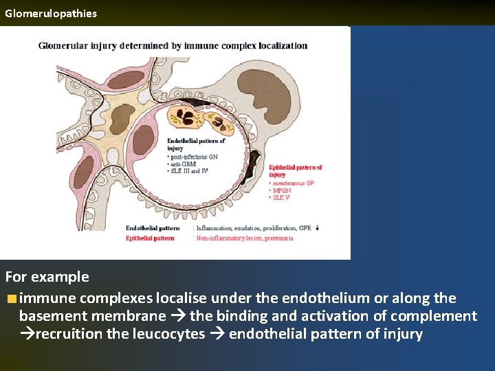 Glomerulopathies For example immune complexes localise under the endothelium or along the basement membrane