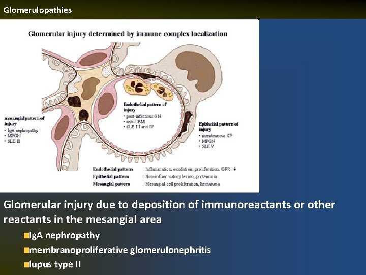 Glomerulopathies Glomerular injury due to deposition of immunoreactants or other reactants in the mesangial