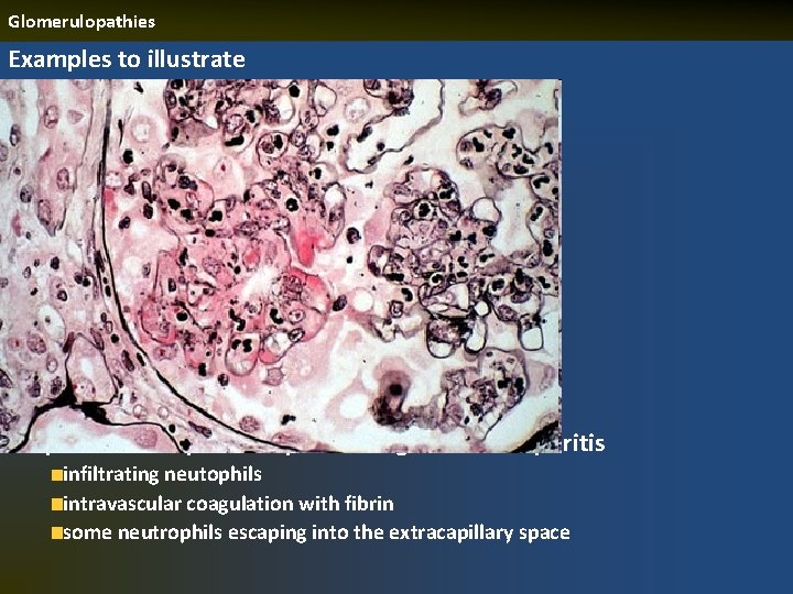 Glomerulopathies Examples to illustrate a patient with post-streptococcal glomerulonephritis infiltrating neutophils intravascular coagulation with