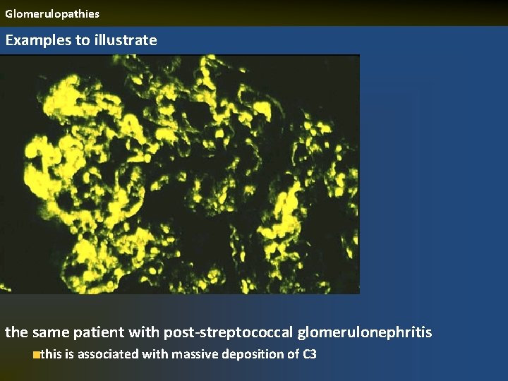 Glomerulopathies Examples to illustrate the same patient with post-streptococcal glomerulonephritis this is associated with