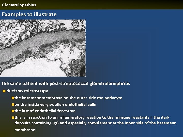 Glomerulopathies Examples to illustrate the same patient with post-streptococcal glomerulonephritis electron microscopy the basement