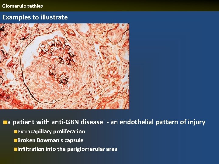 Glomerulopathies Examples to illustrate a patient with anti-GBN disease - an endothelial pattern of