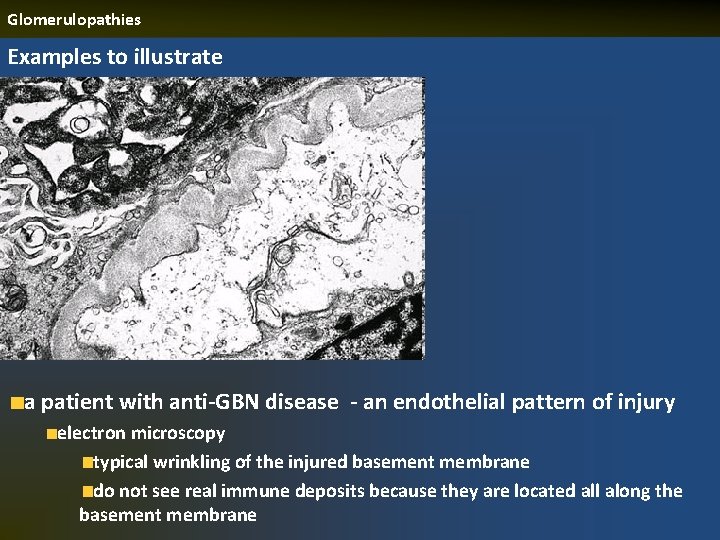 Glomerulopathies Examples to illustrate a patient with anti-GBN disease - an endothelial pattern of