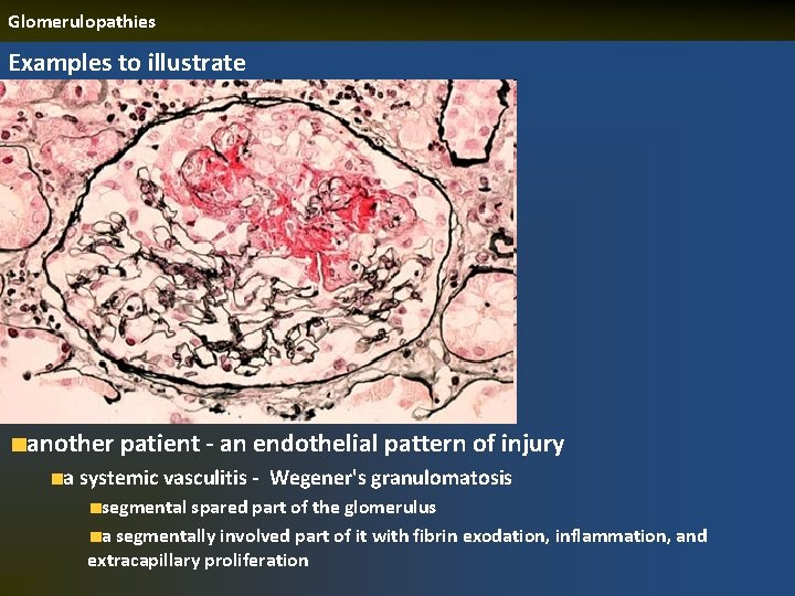 Glomerulopathies Examples to illustrate another patient - an endothelial pattern of injury a systemic