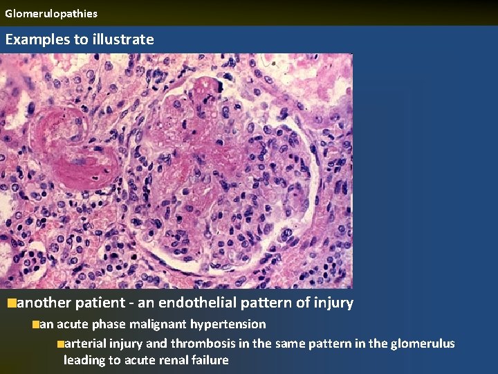 Glomerulopathies Examples to illustrate another patient - an endothelial pattern of injury an acute
