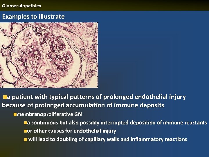 Glomerulopathies Examples to illustrate a patient with typical patterns of prolonged endothelial injury because
