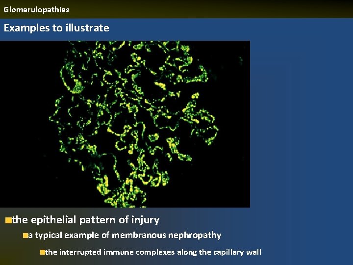 Glomerulopathies Examples to illustrate the epithelial pattern of injury a typical example of membranous