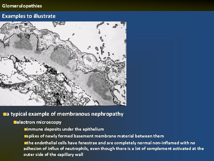 Glomerulopathies Examples to illustrate a typical example of membranous nephropathy electron microscopy immune deposits
