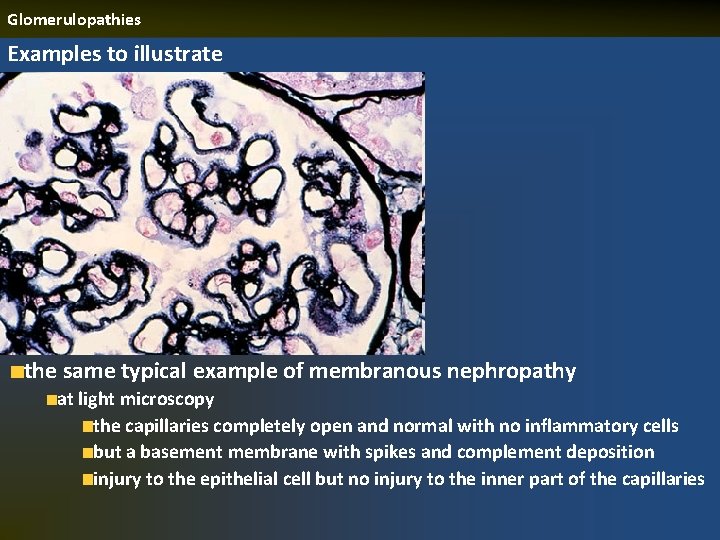 Glomerulopathies Examples to illustrate the same typical example of membranous nephropathy at light microscopy