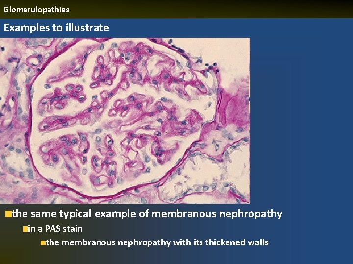 Glomerulopathies Examples to illustrate the same typical example of membranous nephropathy in a PAS