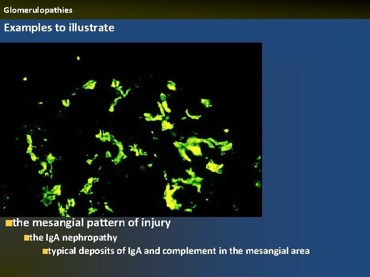Glomerulopathies Examples to illustrate the mesangial pattern of injury the Ig. A nephropathy typical