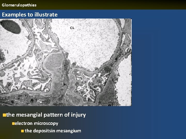 Glomerulopathies Examples to illustrate the mesangial pattern of injury electron microscopy the depositsin mesangium
