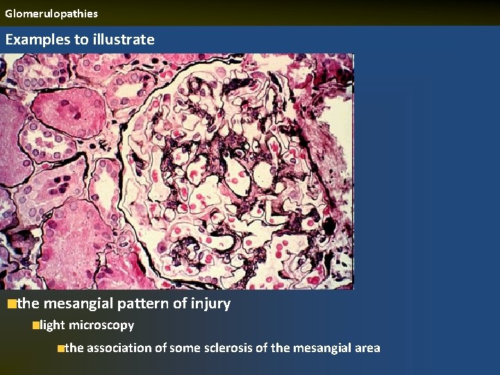 Glomerulopathies Examples to illustrate the mesangial pattern of injury light microscopy the association of