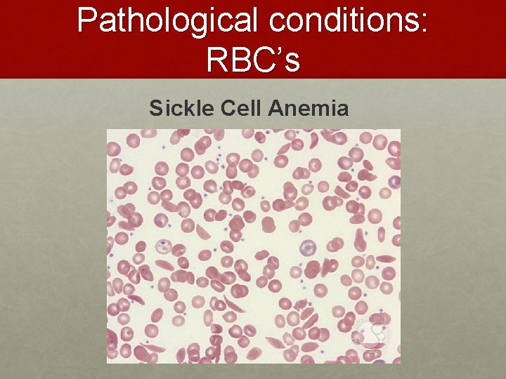 Pathological conditions: RBC’s Sickle Cell Anemia Pathological conditions: RBC’s Sickle Cell Anemia
