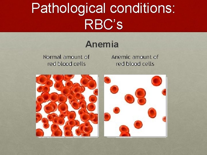 Pathological conditions: RBC’s Anemia Pathological conditions: RBC’s Anemia